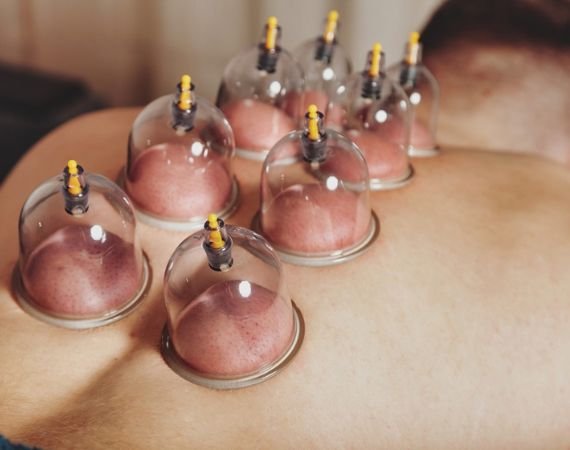 Cupping Therapy