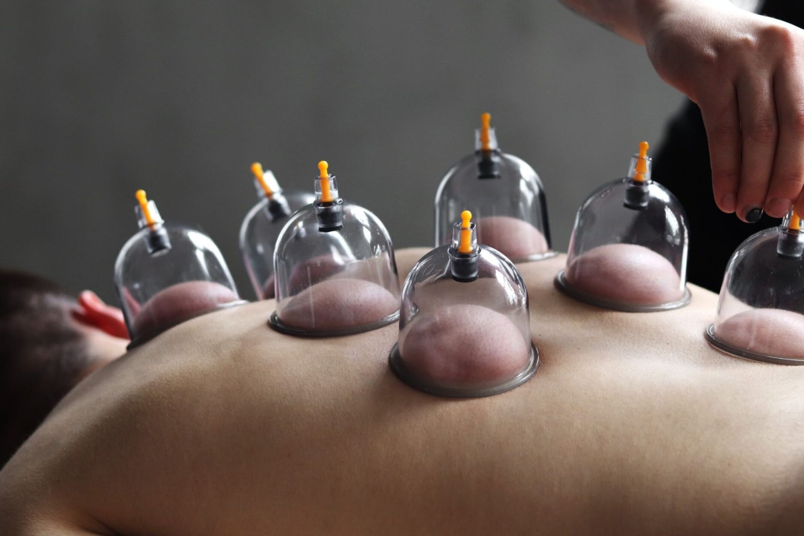 Acupressure and Cupping Therapy